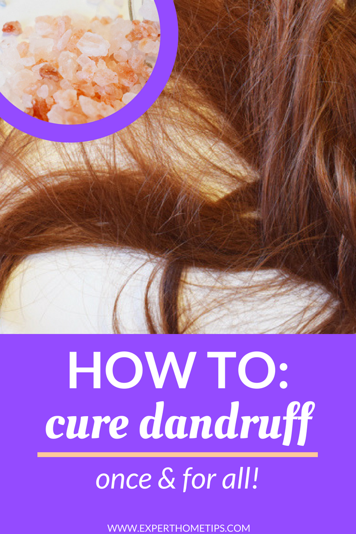 Dandruff Dilemma: Find A Dandruff Cure That WORKS Today! - Expert Home Tips