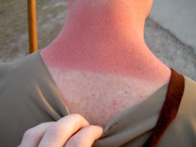 how to get rid of sunburn overnight (14 clever